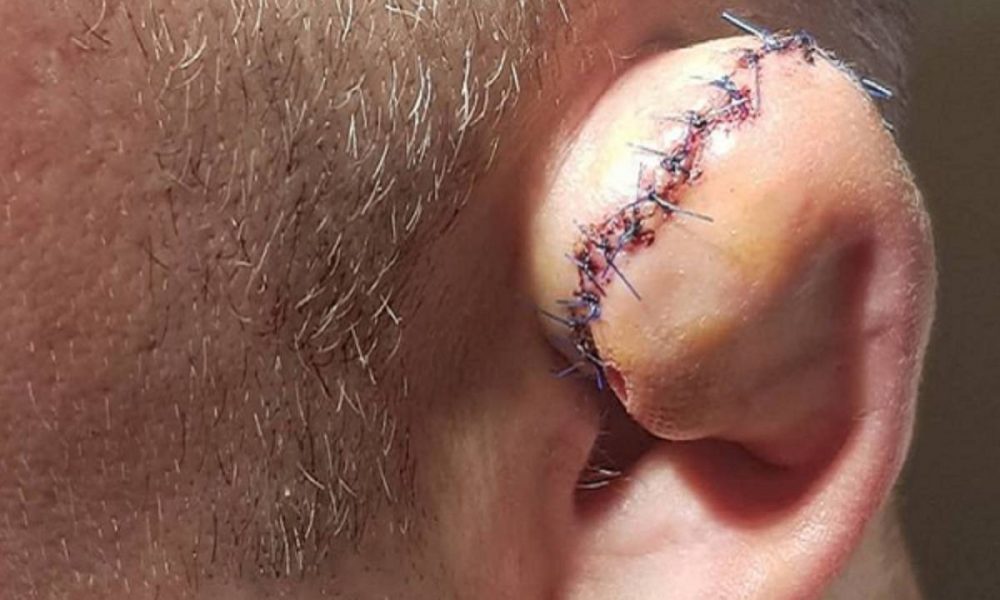 Imagem forte! Golpe rasga orelha de lutador em evento de MMA na Polônia