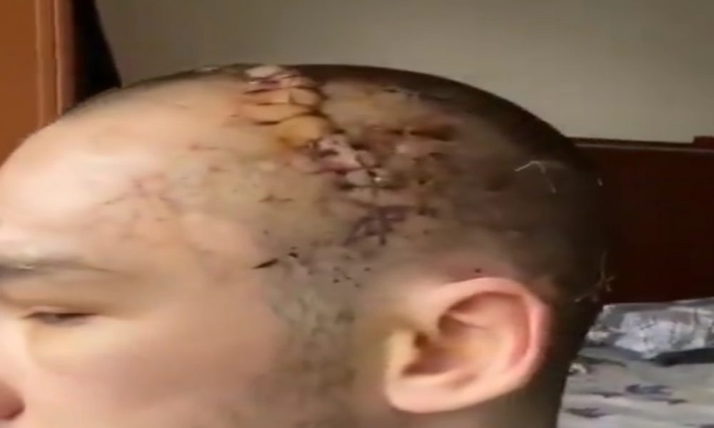 Lutador sofre grave fratura em participação no Karate Combat; veja