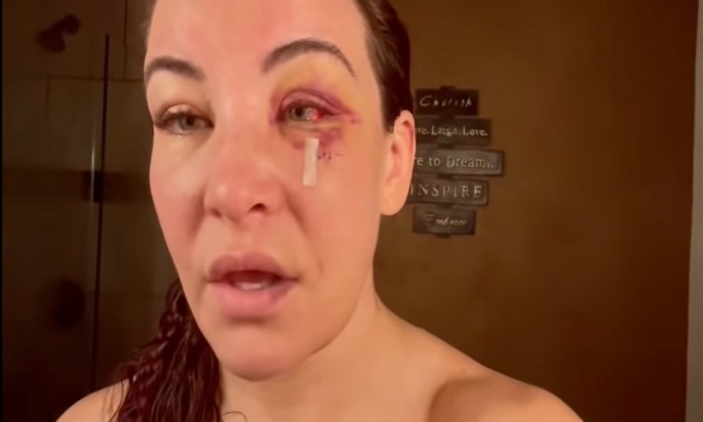 Miesha Tate retira pontos do rosto após derrota para Ketlen Vieira; veja