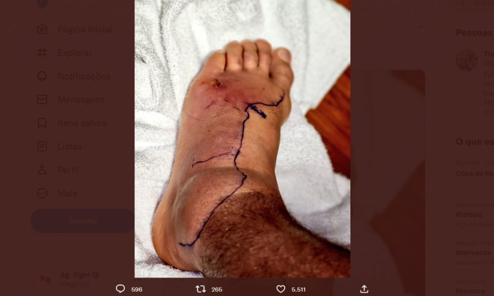 Hospitalizado, Dustin Poirier impressiona ao compartilhar foto do pé inchado; veja