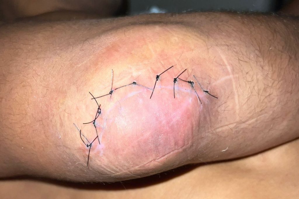 Borrachinha atualiza lesão sofrida no cotovelo