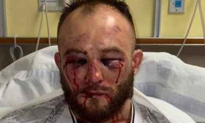 O rosto desfigurado de Mateusz Rebecki após a derrota para Diego Ferreira no UFC St Louis.