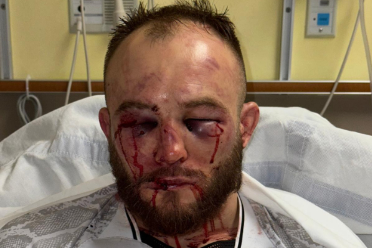 O rosto desfigurado de Mateusz Rebecki após a derrota para Diego Ferreira no UFC St Louis.