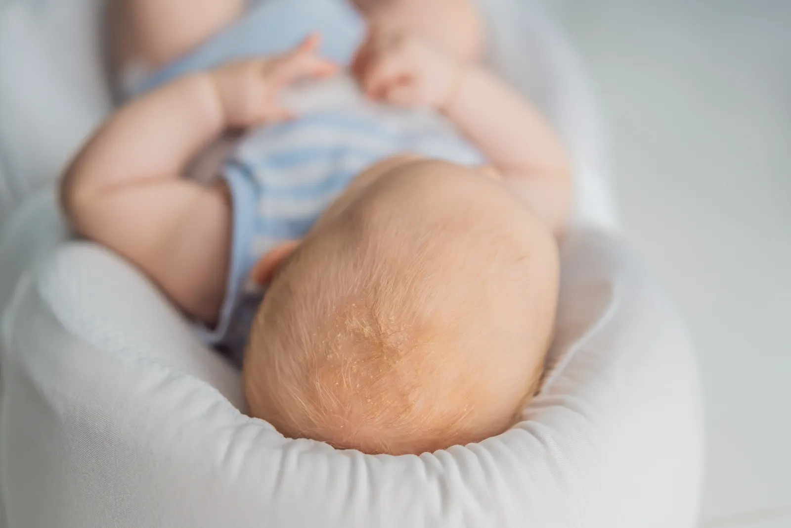Trockene Haut bei Kindern erkennen