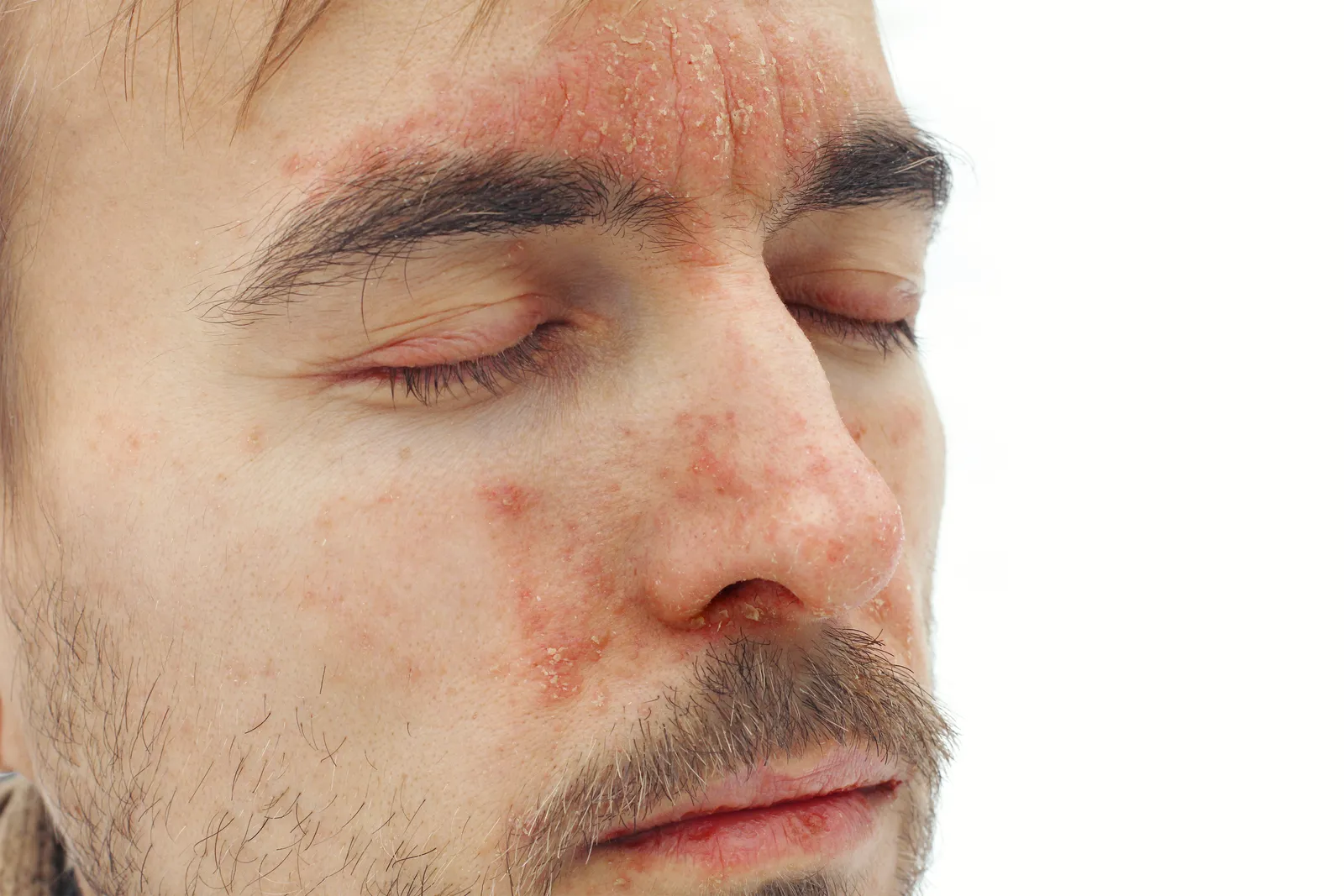 Symptome Gesichtsekzem