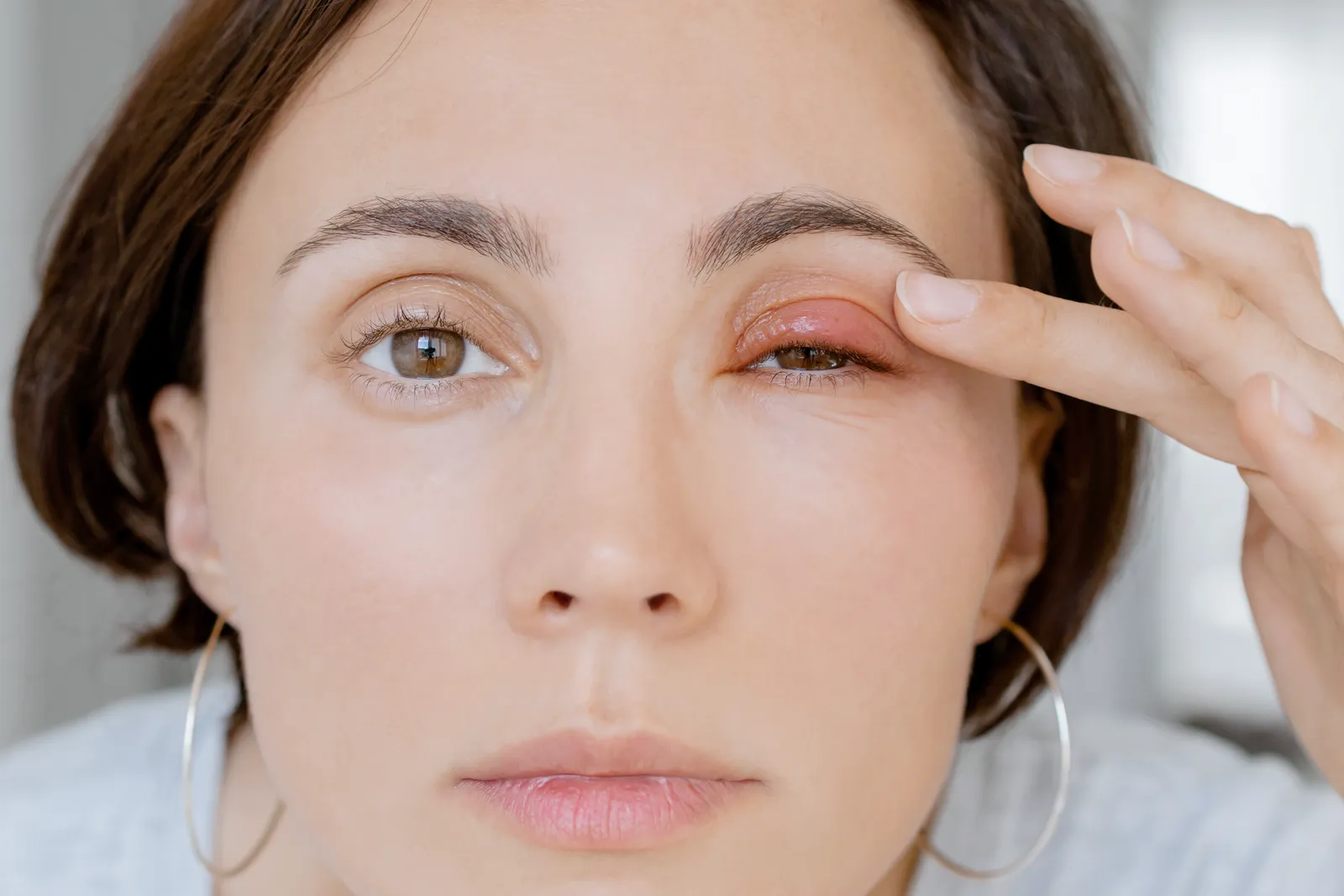 Augenlidekzem Arzttermin