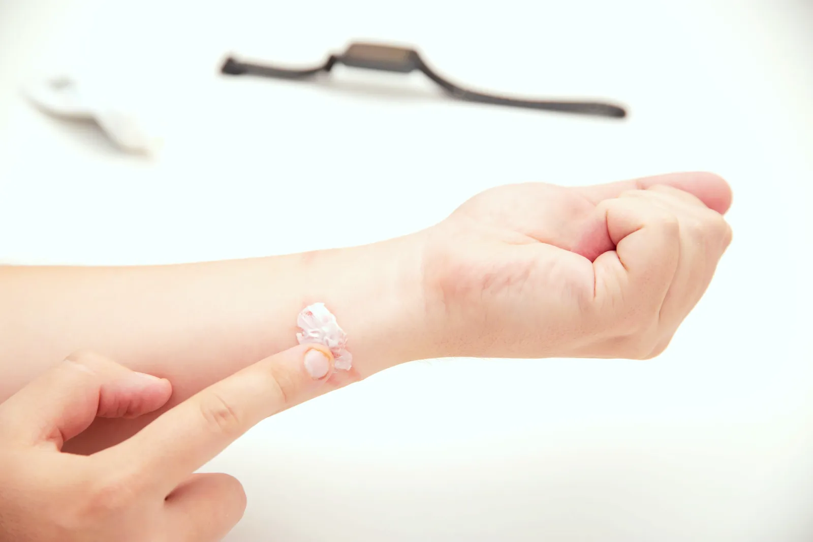 Allergisches Kontaktekzem