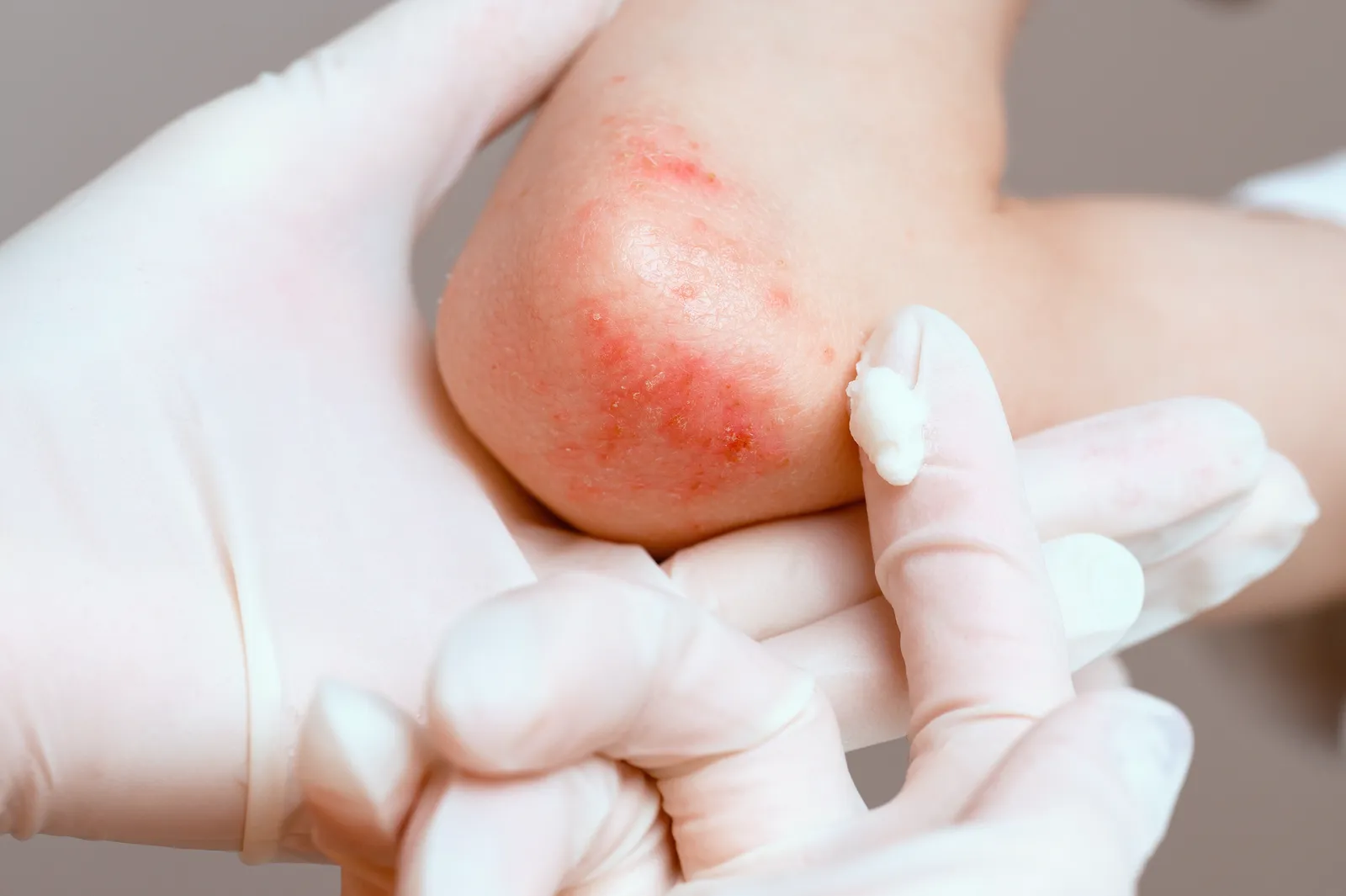 Allergika Gesichtscreme MED