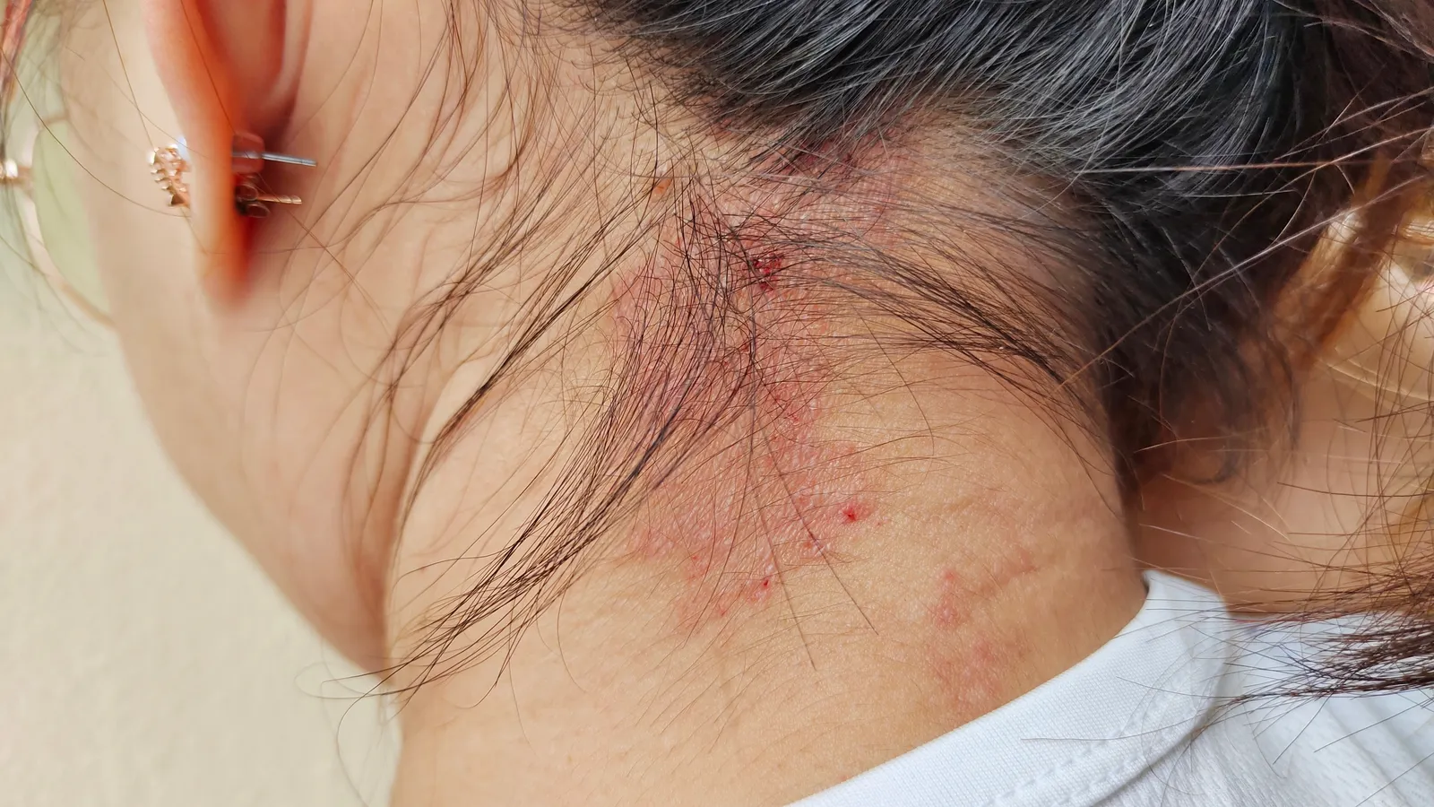 Neurodermitis Ratgeber Übersicht