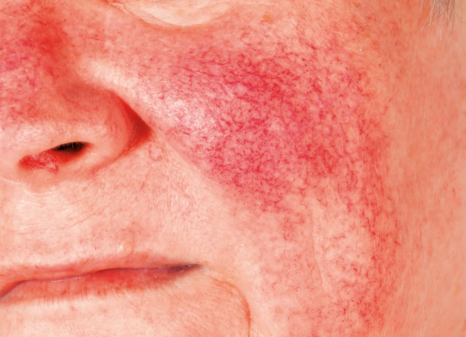 Neurodermitis (atopisches Ekzem)