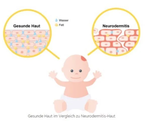 Sonneneinstrahlung auf die Haut