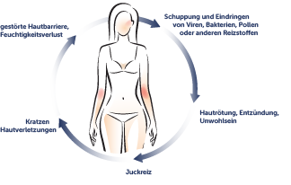 Vorbeugung Neurodermitis