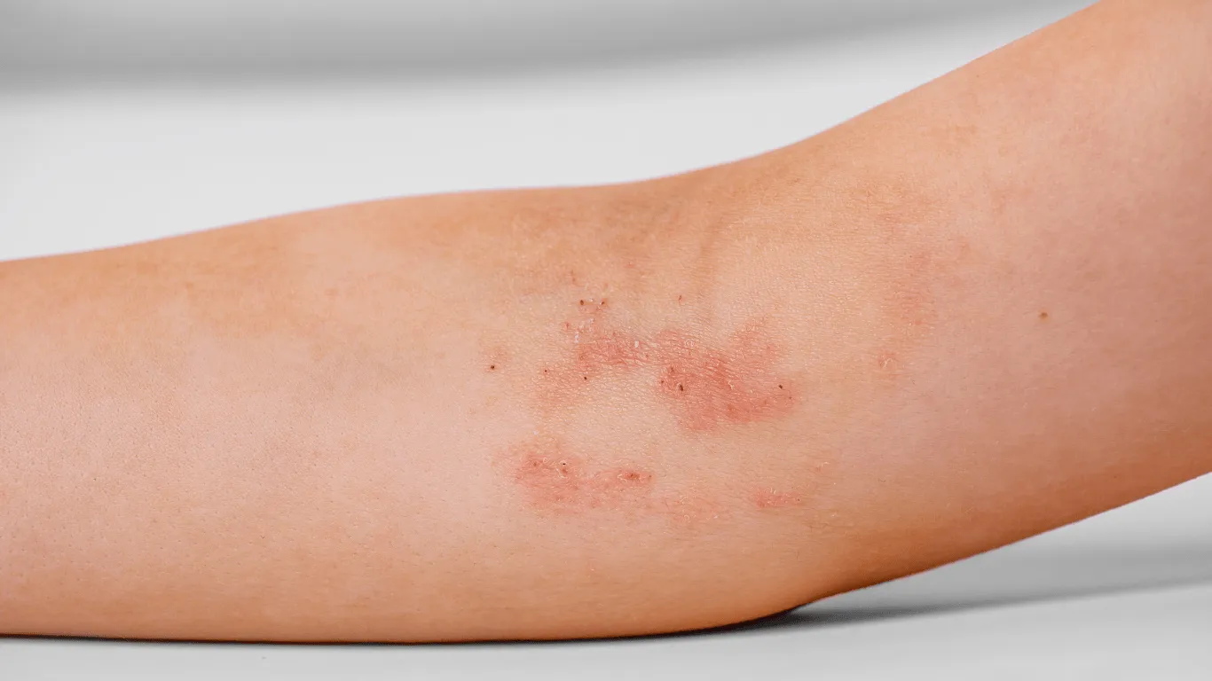 Basistherapie bei Neurodermitis