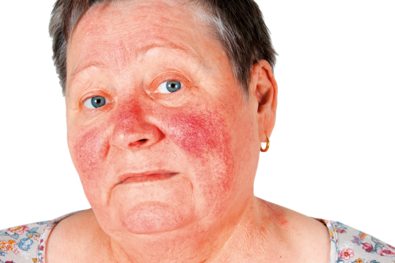 Rötung stoppen und die Hautbarriere bei irritierter und Rosacea-Haut stärken