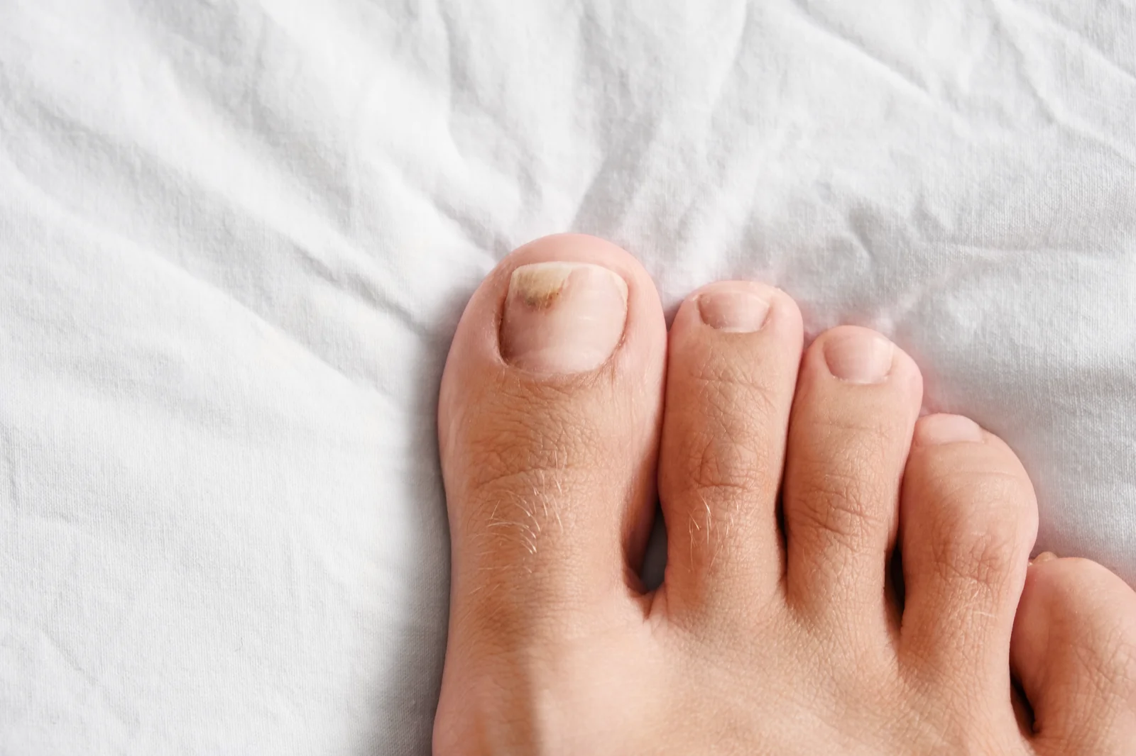 Nagelpilz erkennen und Nägel gezielt begleiten