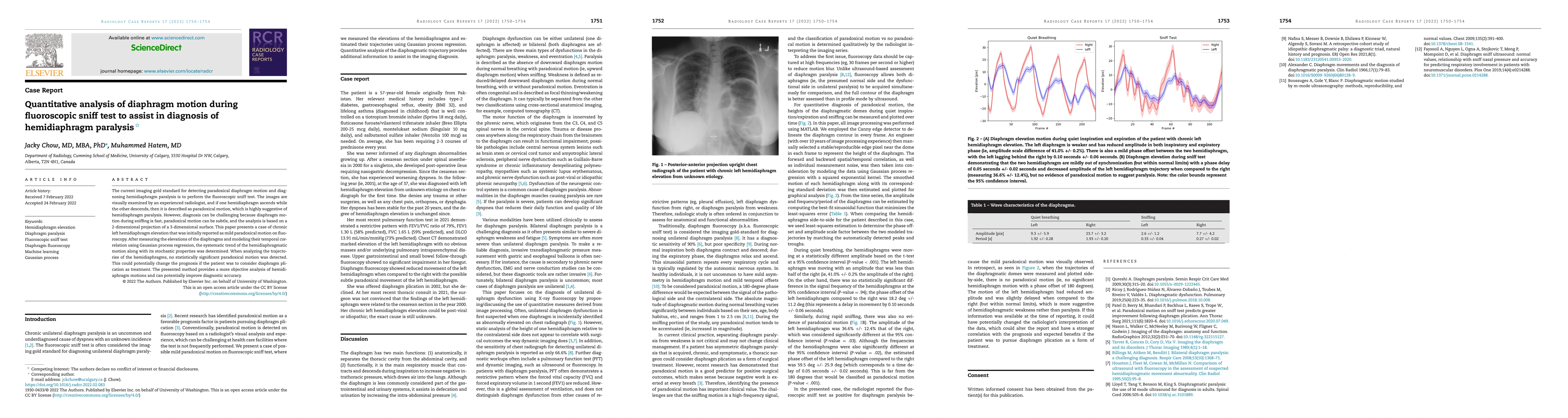 Thumbnail for Quantitative analysis of diaphragm motion during fluoroscopic sniff test
  to assist in diagnosis of hemidiaphragm paralysis
