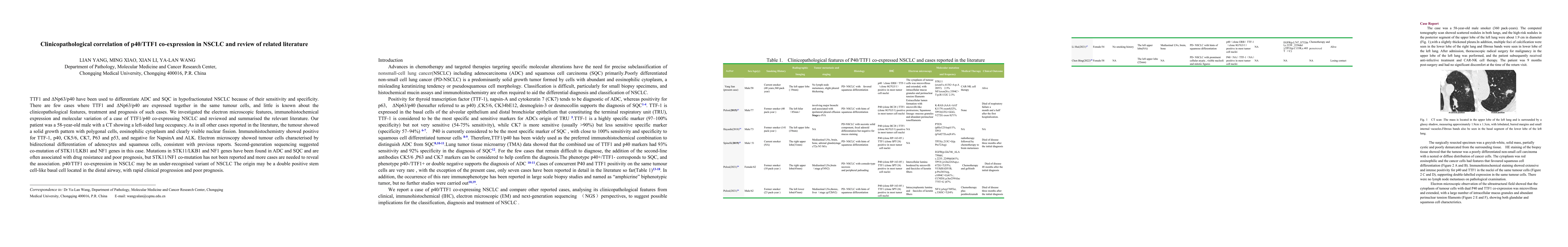 Thumbnail for Clinicopathological correlation of p40/TTF1 co-expression in NSCLC and
  review of related literature
