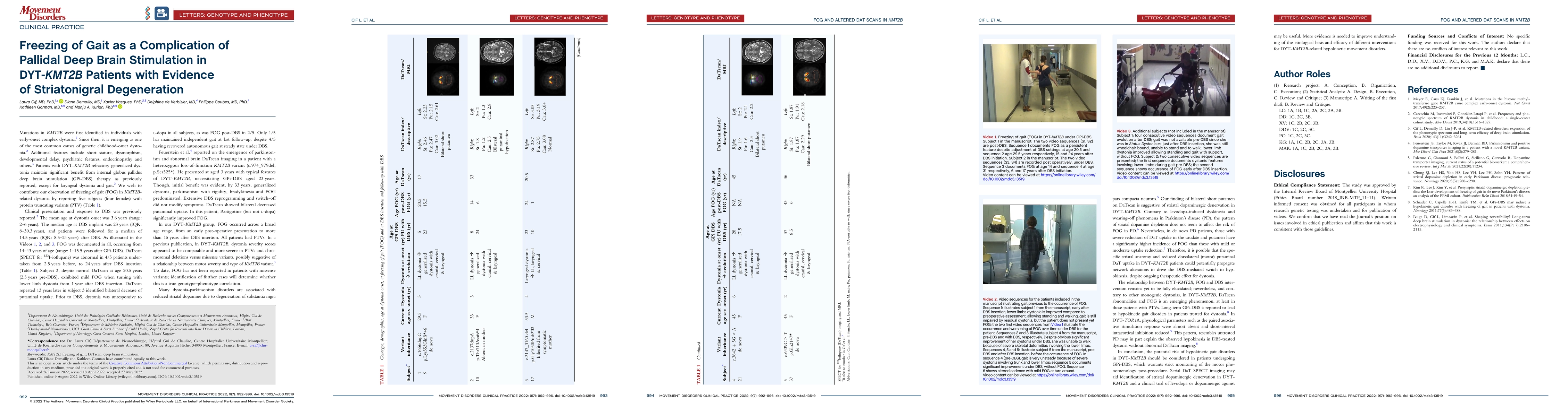 Thumbnail for Freezing of Gait as a Complication of Pallidal Deep Brain Stimulation in
  DYT- KMT2B Patients with Evidence of Striatonigral Degeneration
