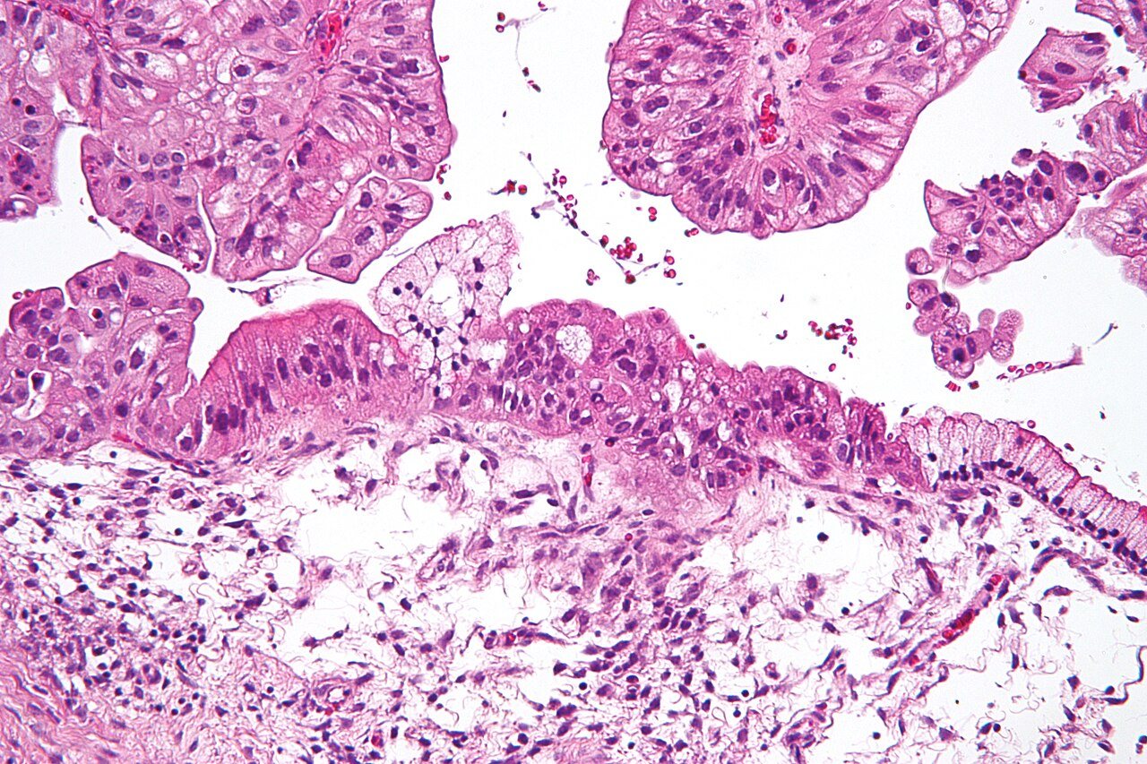 [Correspondence] Unmasking inequity: emergency presentations in ovarian cancer care – Authors’ reply