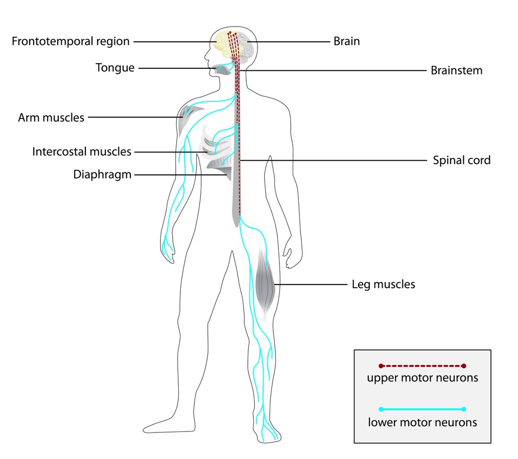 First for RNA therapy: man with rare motor-neuron disease improves after treatment
