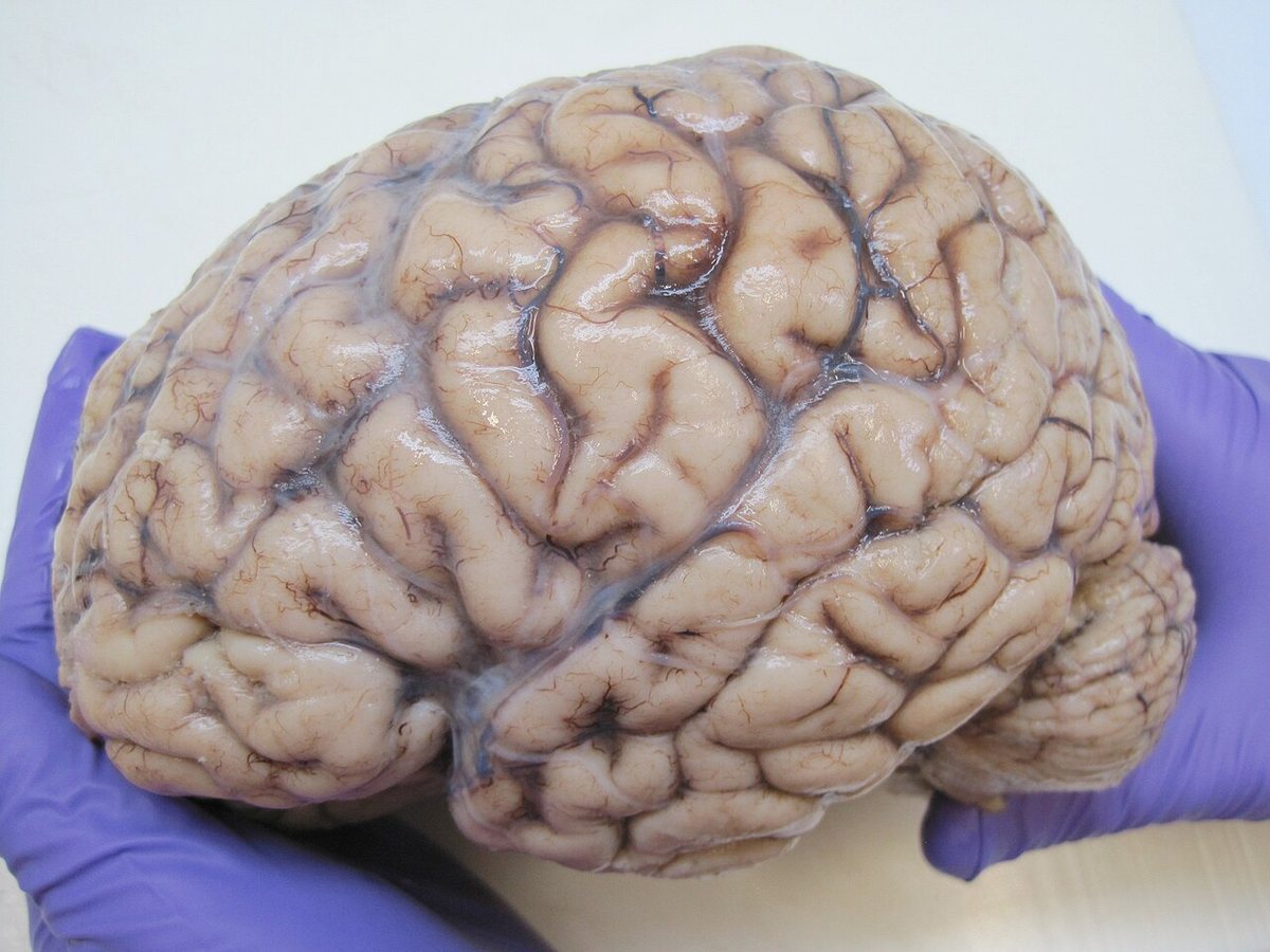 Gene alteration in human brain suggests genetic and epigenetic roots of major depression