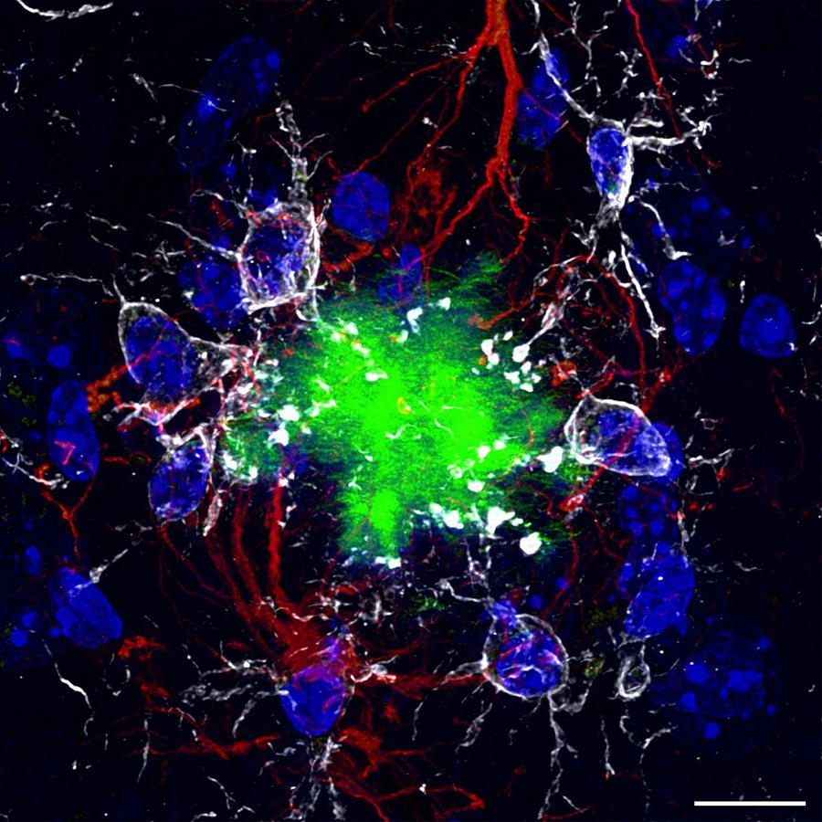 Glucosamine, a popular joint supplement, linked to faster Alzheimer’s progression