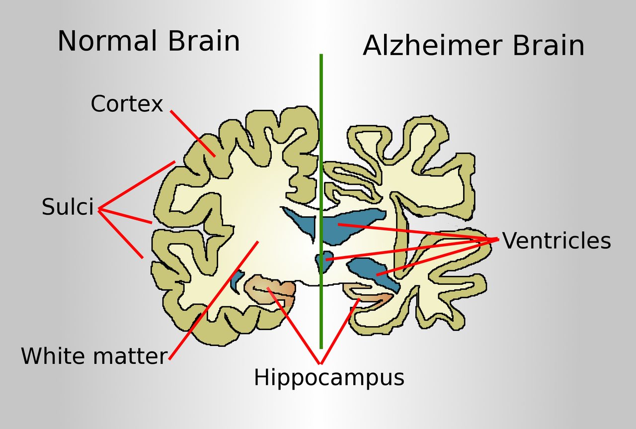Scientists find a new layer of Alzheimer’s hidden in the genome