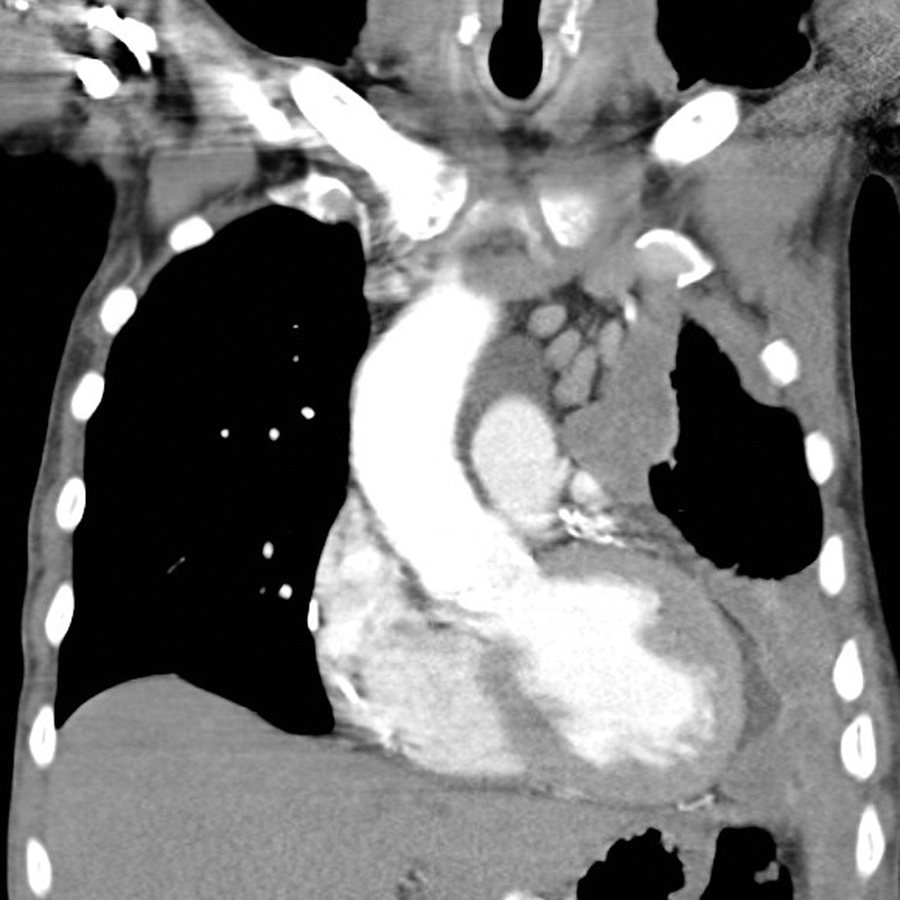 New mesothelioma drug turns cancer’s own defenses against it