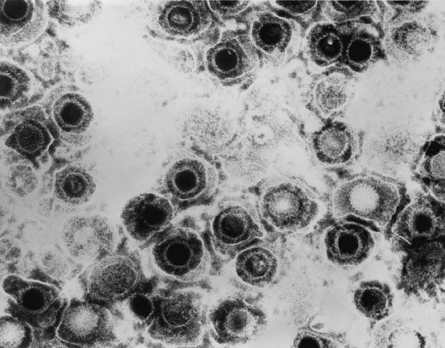 Cold Sore Virus Leaves Mark on Brain’s Immune Cells, Animal Study Shows