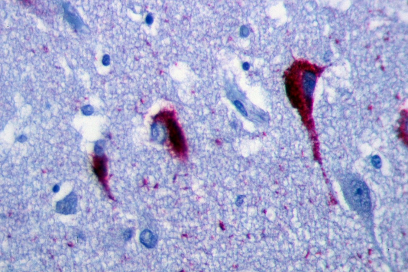 Neurofibrillary tangles in the Hippocampus of an old person with Alzheimer-related pathology, immunohistochemistry for tau protein.JPG