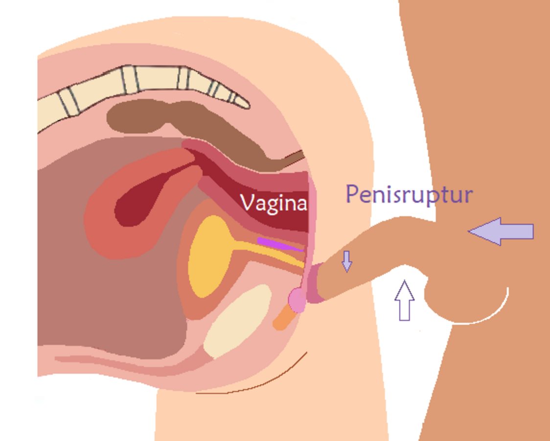 Risk of penile injury during doggy style intercourse