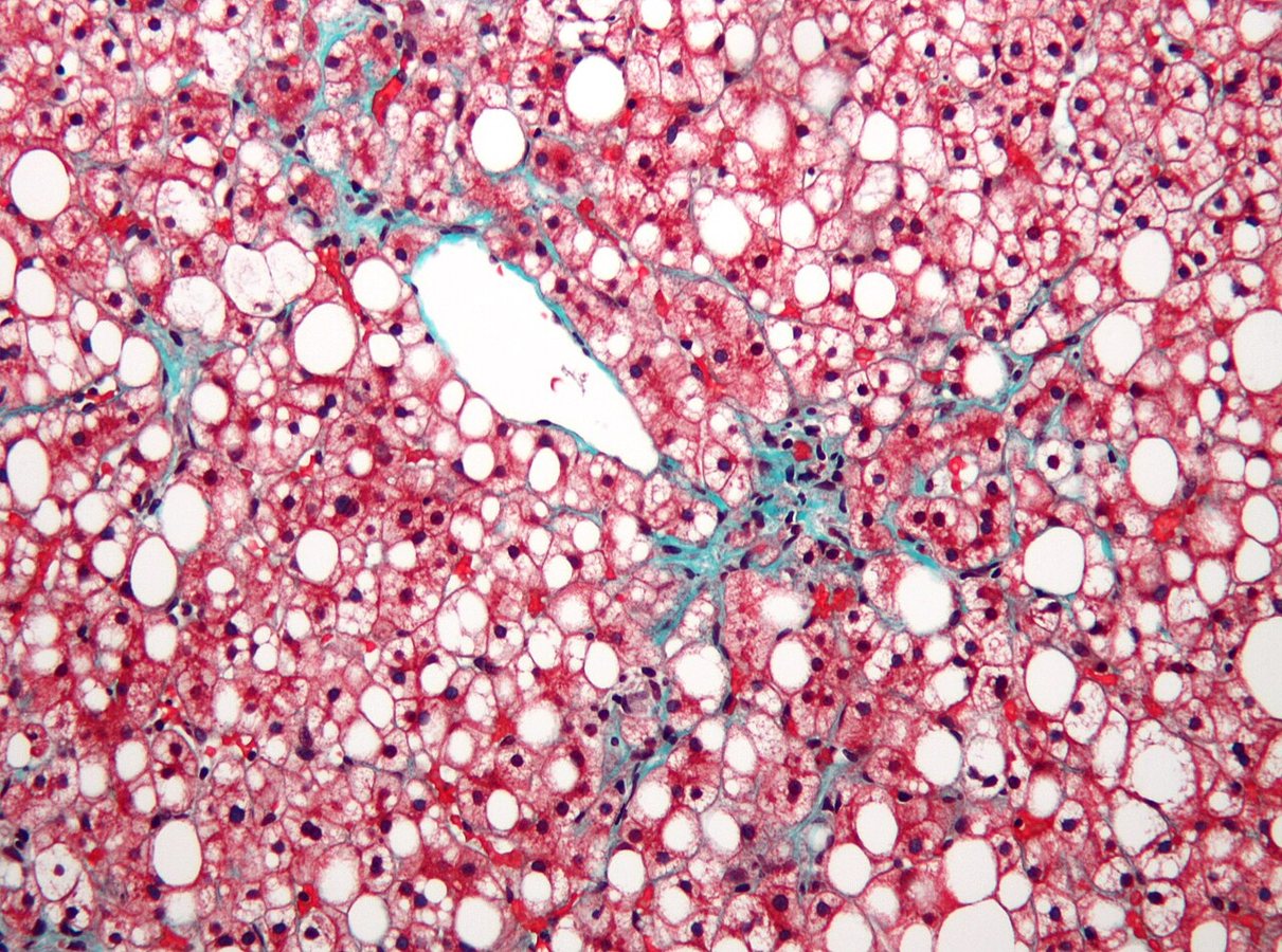 A plastic once thought harmless may be fueling fatty liver disease