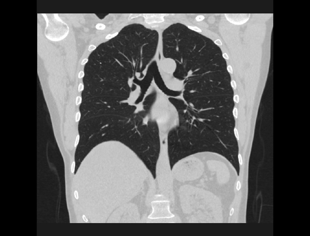 COR-2-STND-CHEST-LUNGS.jpg