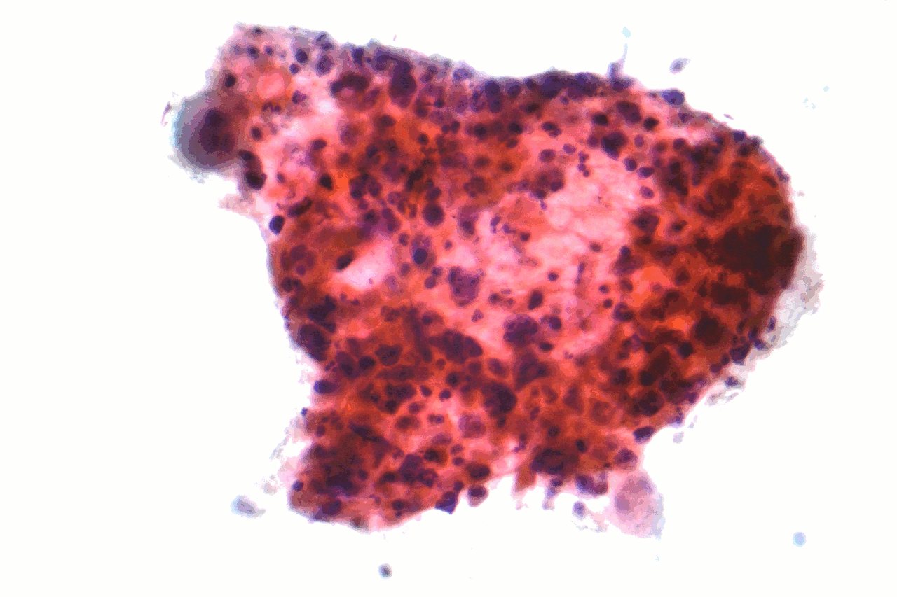 Neoadjuvant durvalumab plus chemotherapy in resectable or borderline resectable non-small-cell lung cancer: the phase 2 MDT-BRIDGE trial