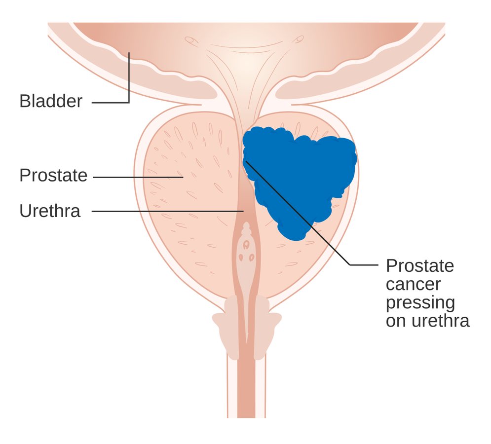 Scientists find a new weakness in treatment-resistant prostate cancer