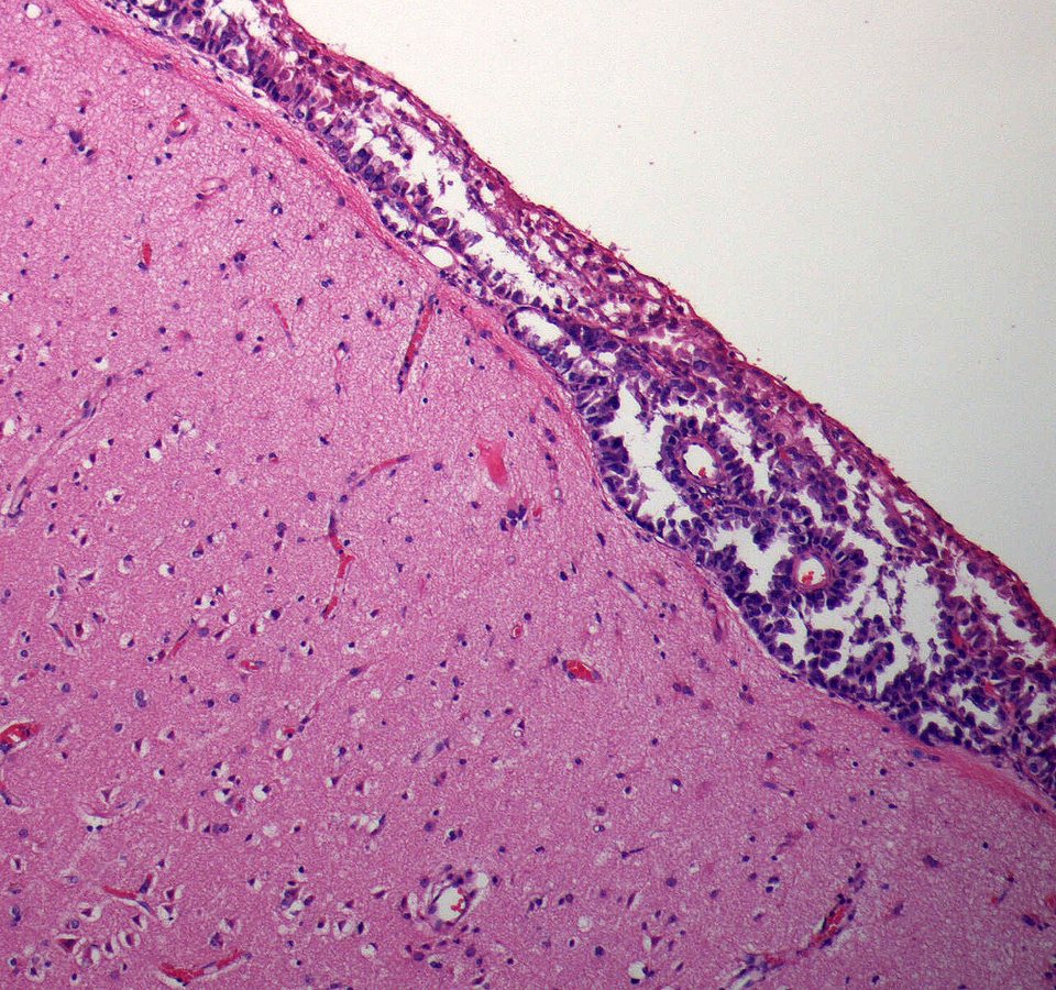 This common vitamin could help fight one of the deadliest brain cancers