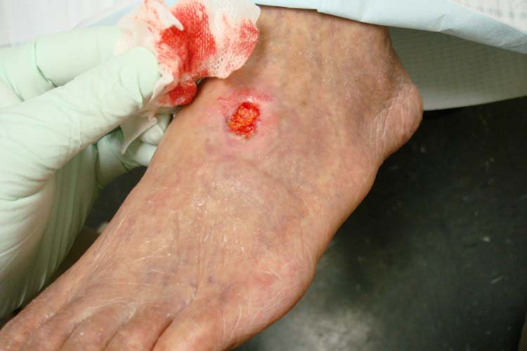 [Editorial] Peripheral arterial disease: counting what matters