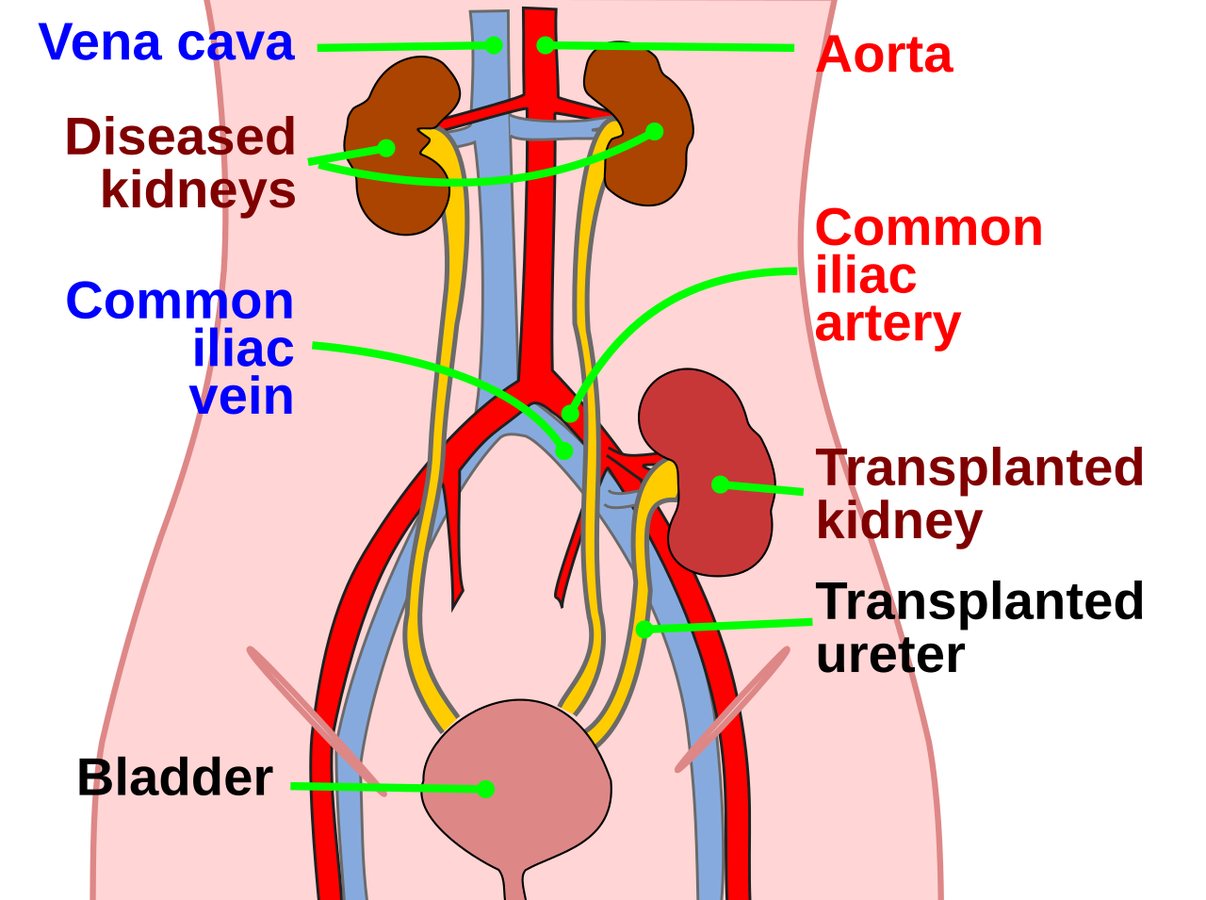 Pig kidney kept a man off dialysis for nine months in world first