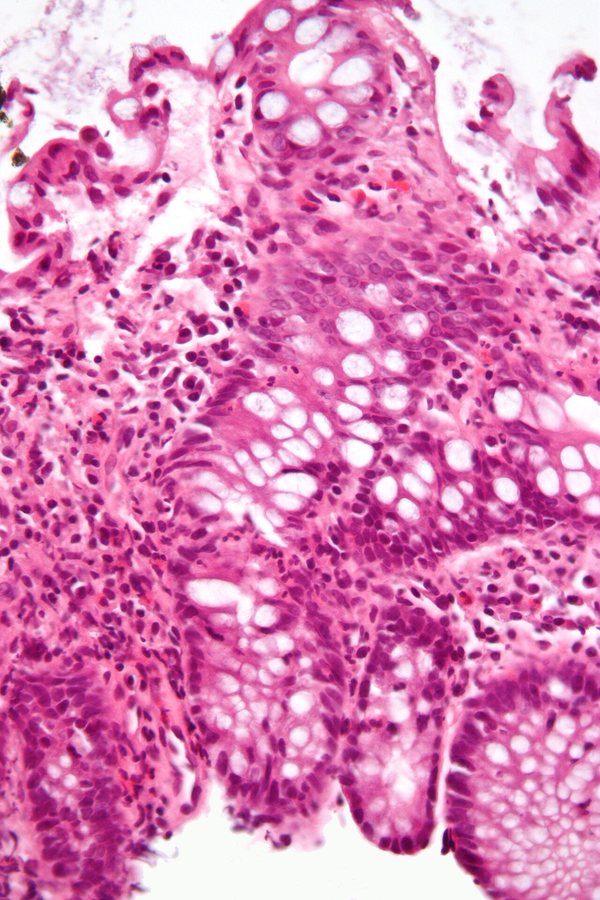 Researchers hope powerful new microscope will reveal ‘root cause’ of incurable bowel disease