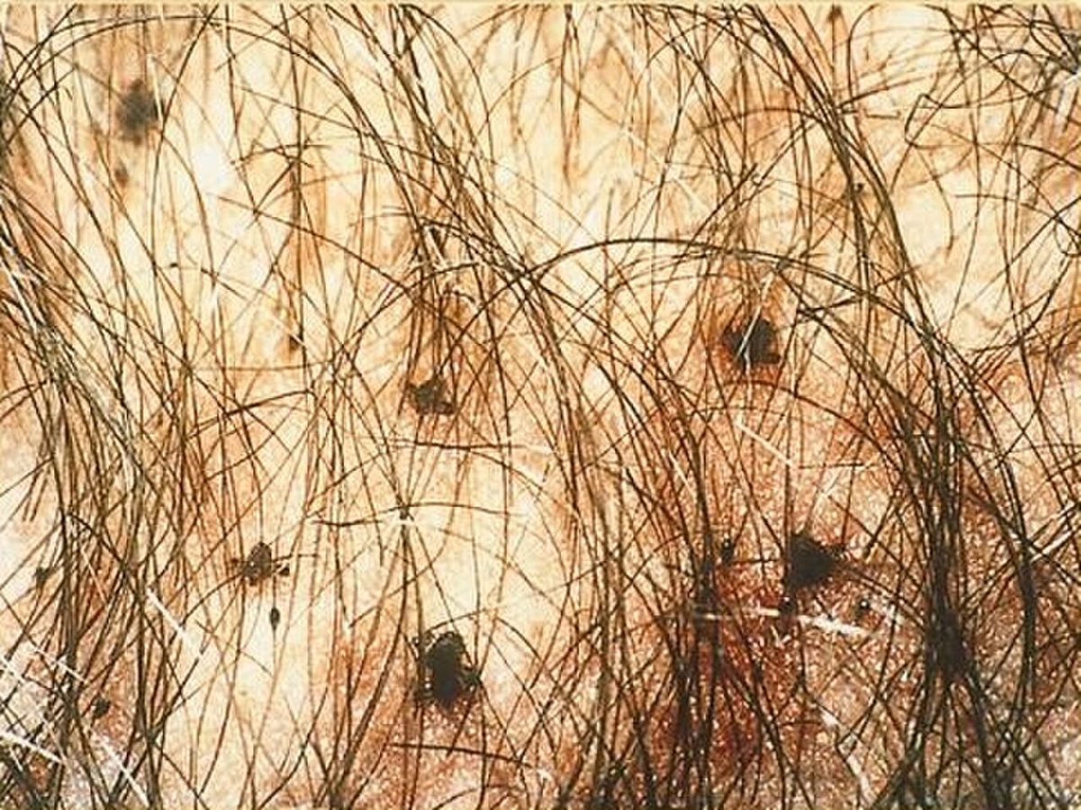 Pubic hair infested with crab lice