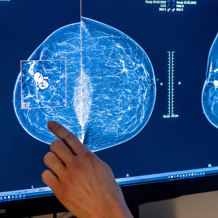 Mammografie-Screening - Altersgrenze für Brustkrebs-Früherkennung wird auf 45 Jahre herabgesetzt