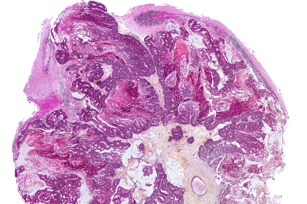 Smart nanoparticles light up brain cancer and destroy what surgery misses