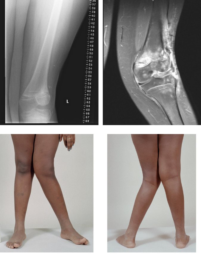 Hallux valgus komt bij 1 op de 4 60-plussers voor. Arts legt uit wat je kan doen tegen de pijn en wanneer een operatie zich opdringt