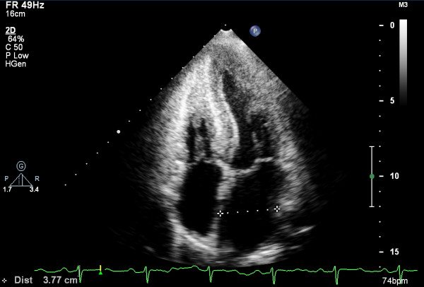Eplontersen with and without background transthyretin stabilizers in transthyretin amyloid cardiomyopathy: secondary analysis of a phase 3, randomized controlled trial