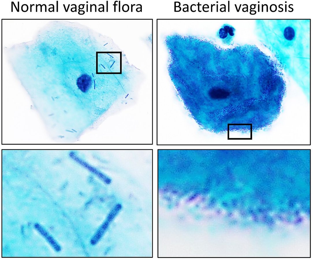 Underlying causes of recurrent bacterial vaginosis identified by Australian scientists