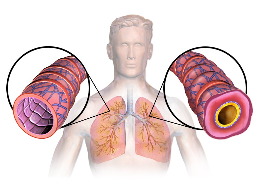 [Editorial] The unmet needs of people living with severe asthma