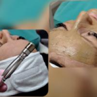Tratament facial cu microdermabraziune diamant 