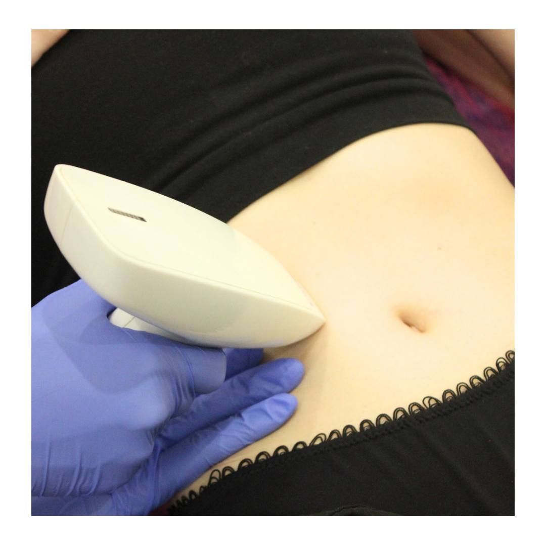 VelaShape III