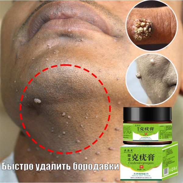 Wart & Mole Removal Cream: 20g for Papillomas, Warts, & Calluses