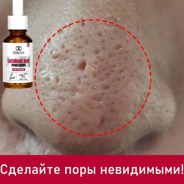 Fruit Acid Face Serum: Pore Minimizing &amp; Acne Clearing (30ml)